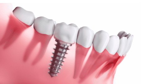 danties implantas